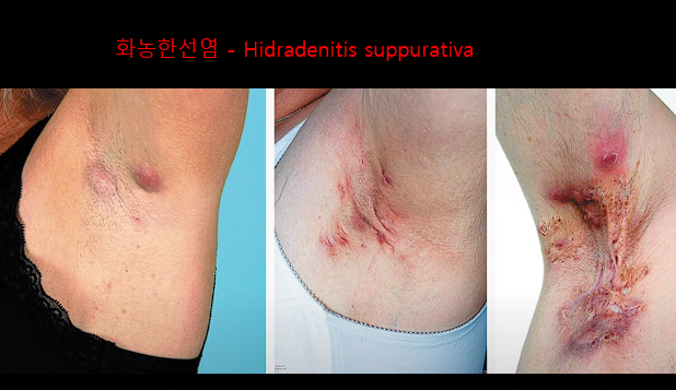 겨드랑이 염증