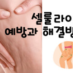 셀룰라이트 해결방법