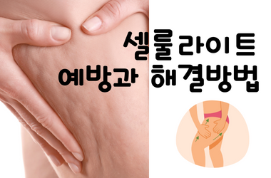 셀룰라이트 해결방법