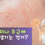 기미주근깨원인