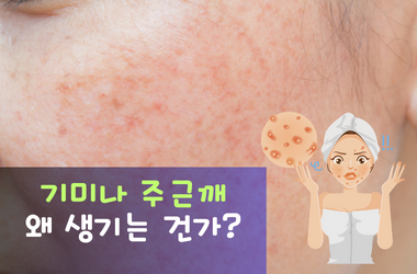 기미주근깨원인